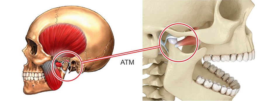 Articulação Temporomandibular - ATM - Rover Ortodontia e ATM - Cascavel