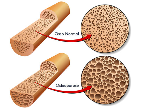 osso normal e osso com osteoporose