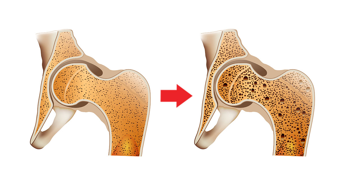 Osteoporose: por que acontece e como tratar? - Saúde & Benessere - Saúde &  Benessere