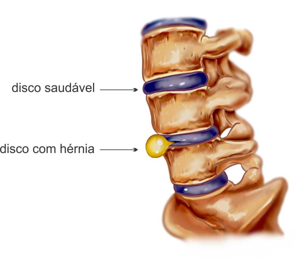 disco vertebral saudavel e disco com hernia