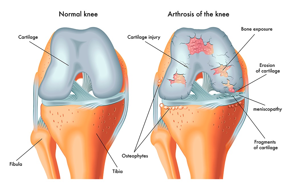 articulação do joelho saudável X com artrose